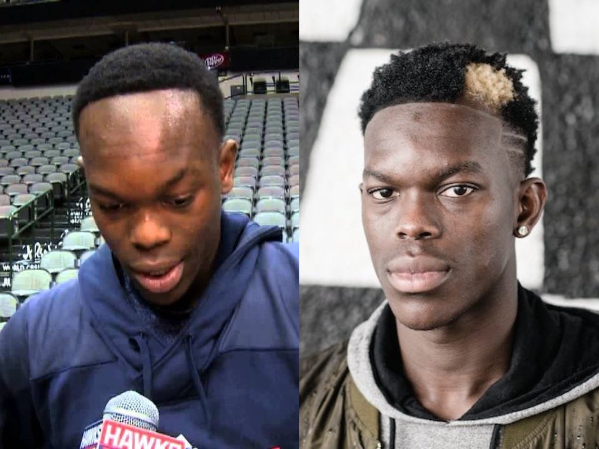 dennis schroder hairline