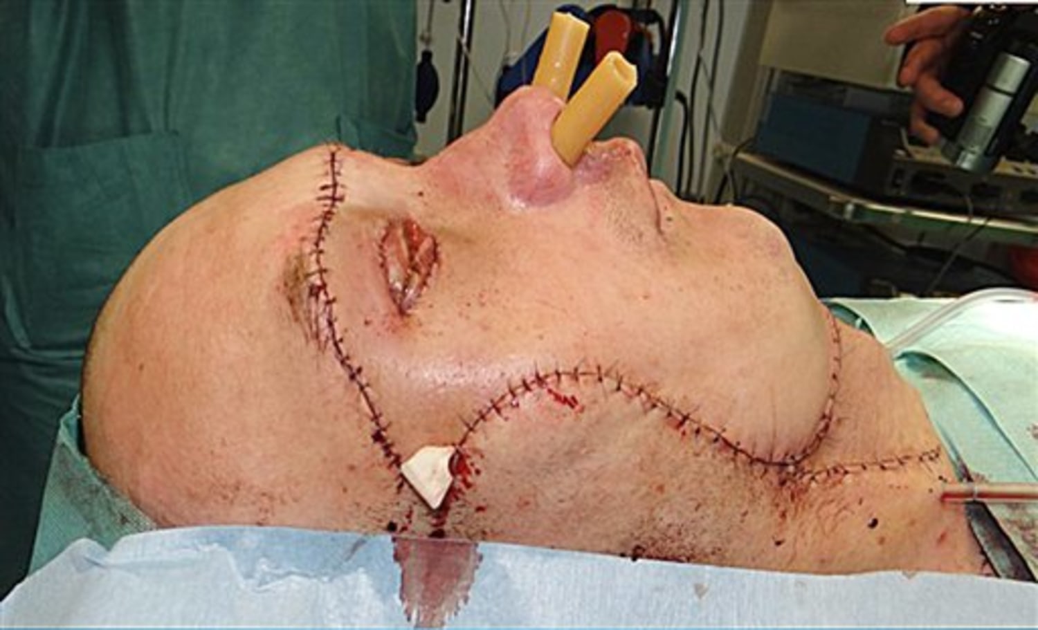 2009 face split incident