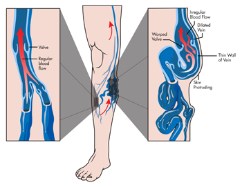 vein reflux icd 10