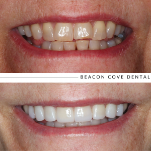 beacon cove dental