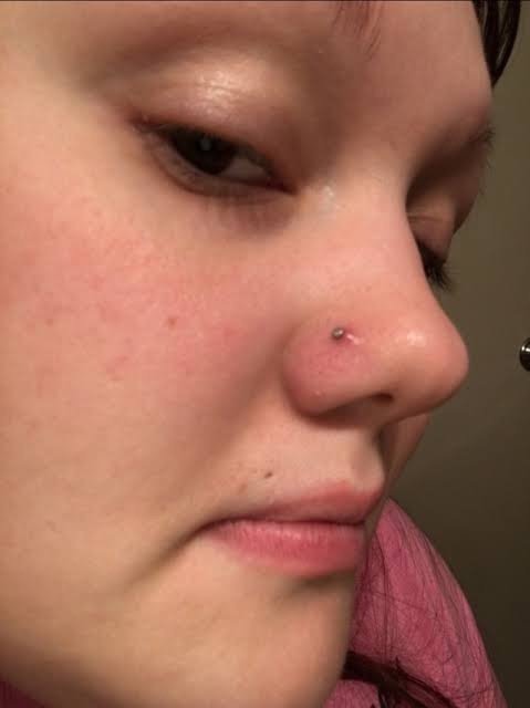 granuloma nose ring