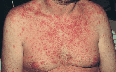 pictures of lamotrigine rash