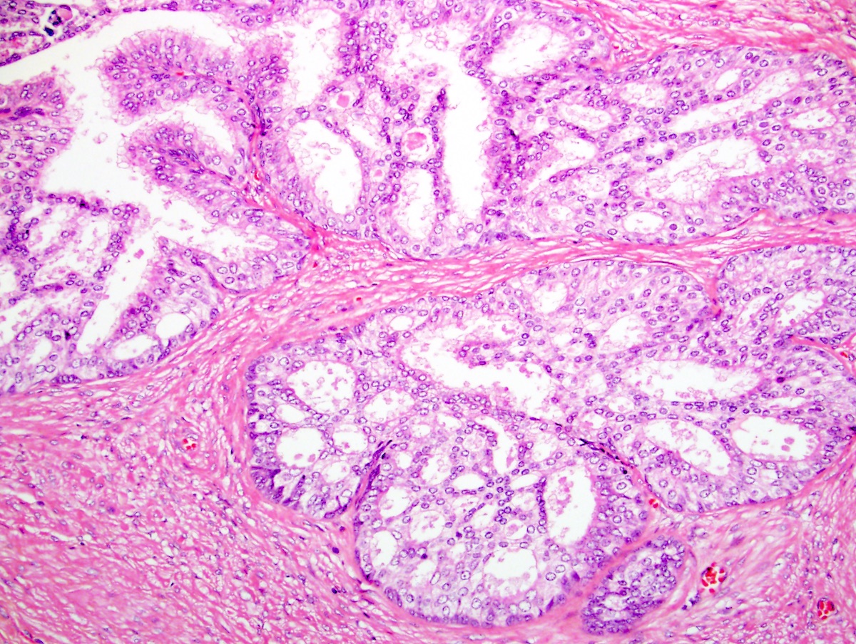 prostate pathology outlines