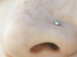 how to get rid of keloid nose piercing