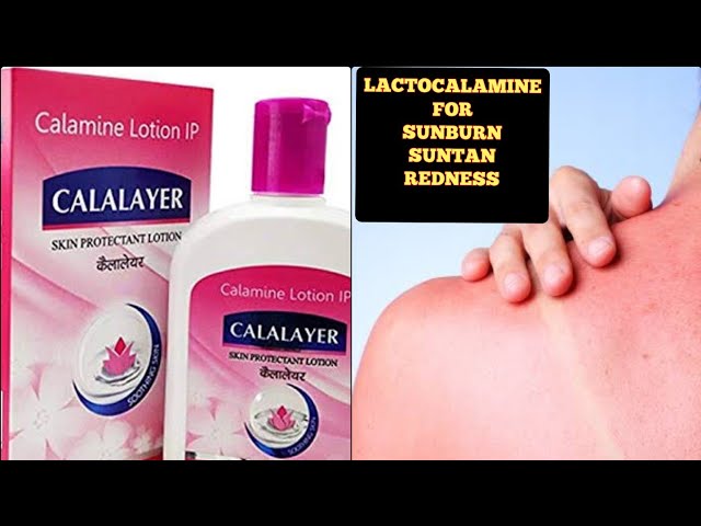 lacto calamine for sunburn