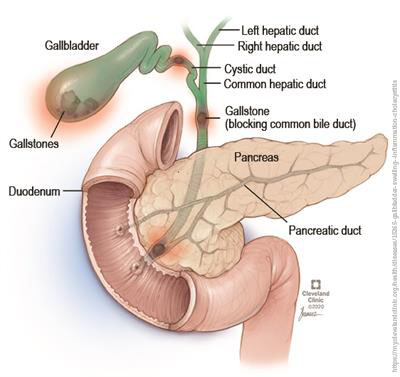 cholecystitis icd 10