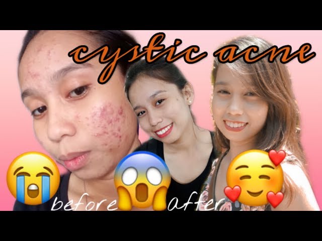 cavite skin clinic review