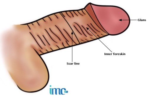 imc circumcision