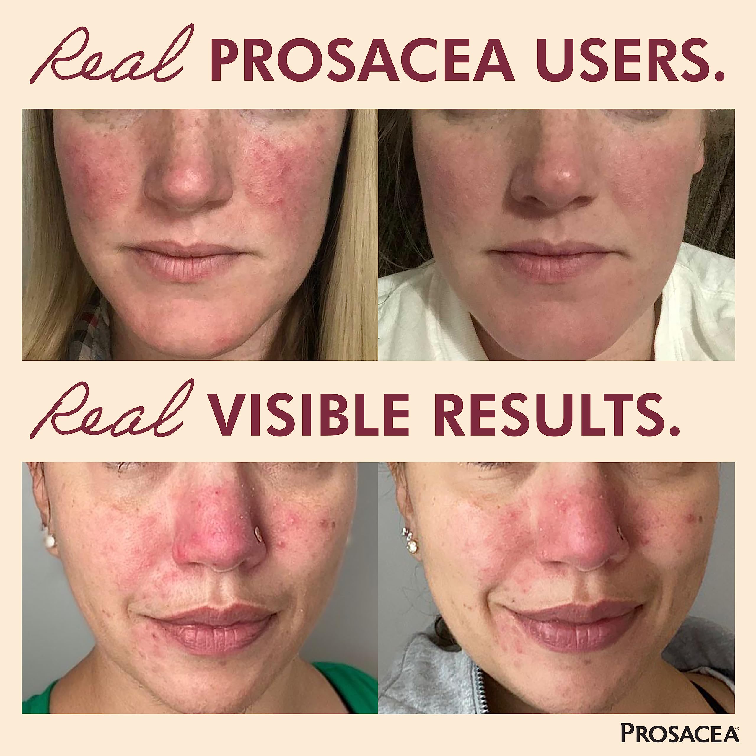 prosacea reviews for rosacea