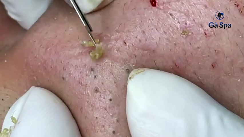 worst blackheads removal