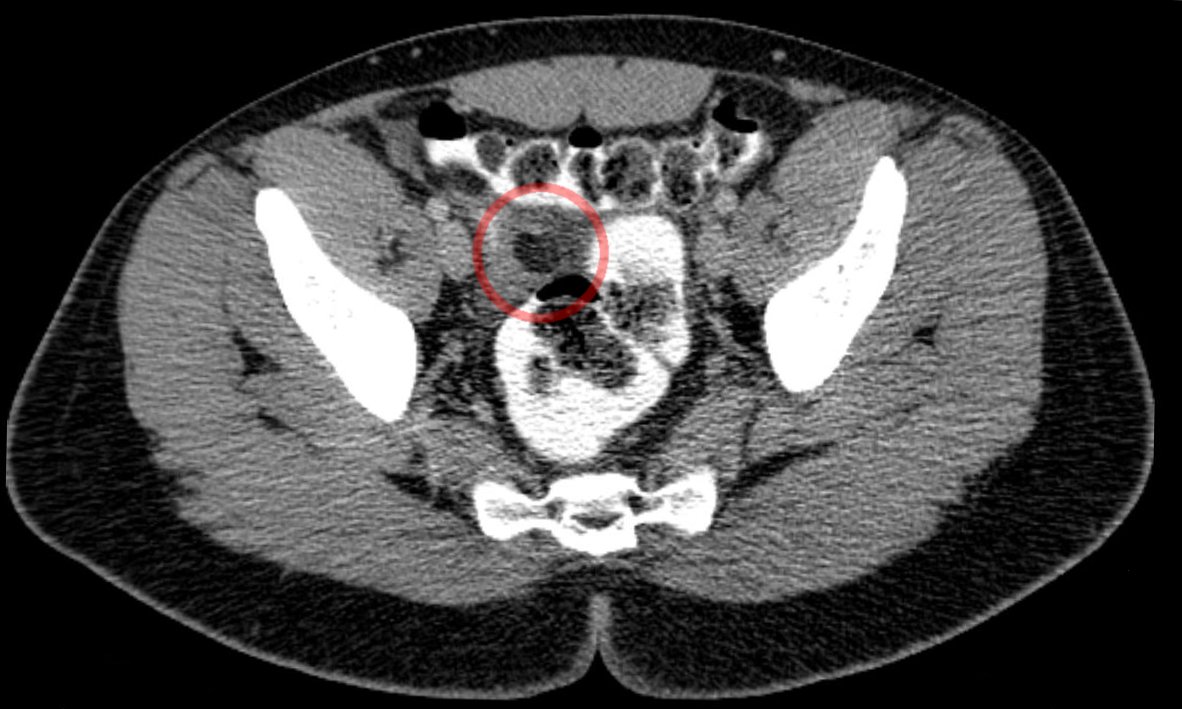 epiploic appendagitis icd 10