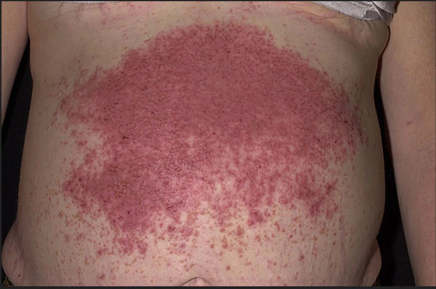 coeliac disease rash photos