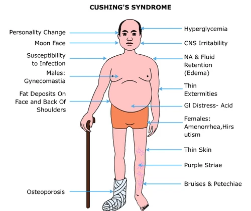 is cushing syndrome treatable