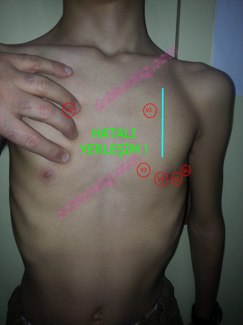 ekg bağlanması renkler