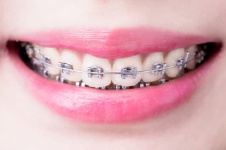 teeth braces images