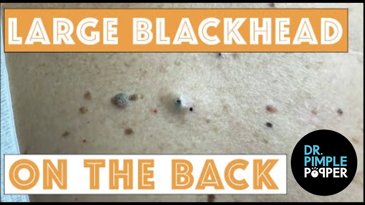 massive blackhead on back