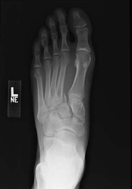 lisfranc fracture radiology