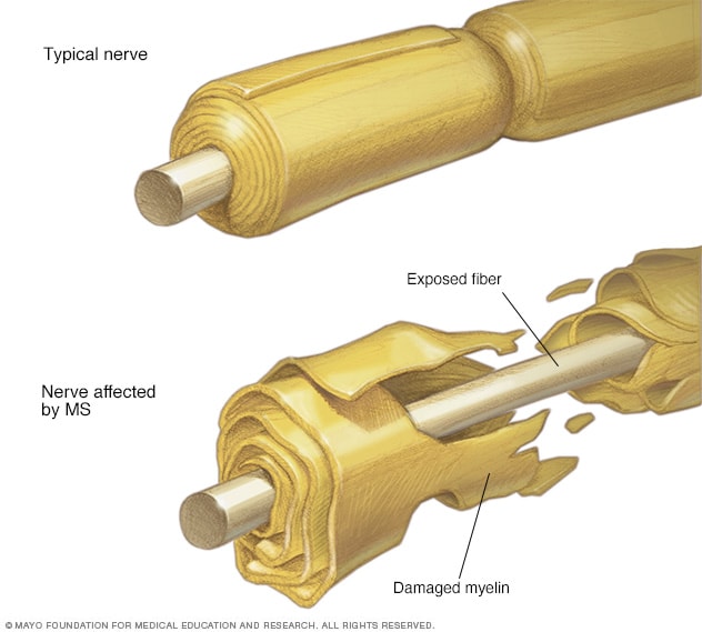 multiple sclerosis mayo clinic