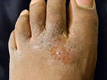 athletes foot meaning in tamil