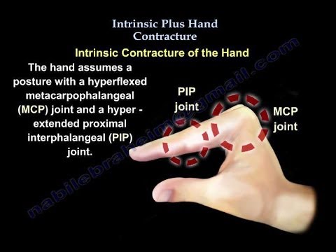 intrinsic plus deformity