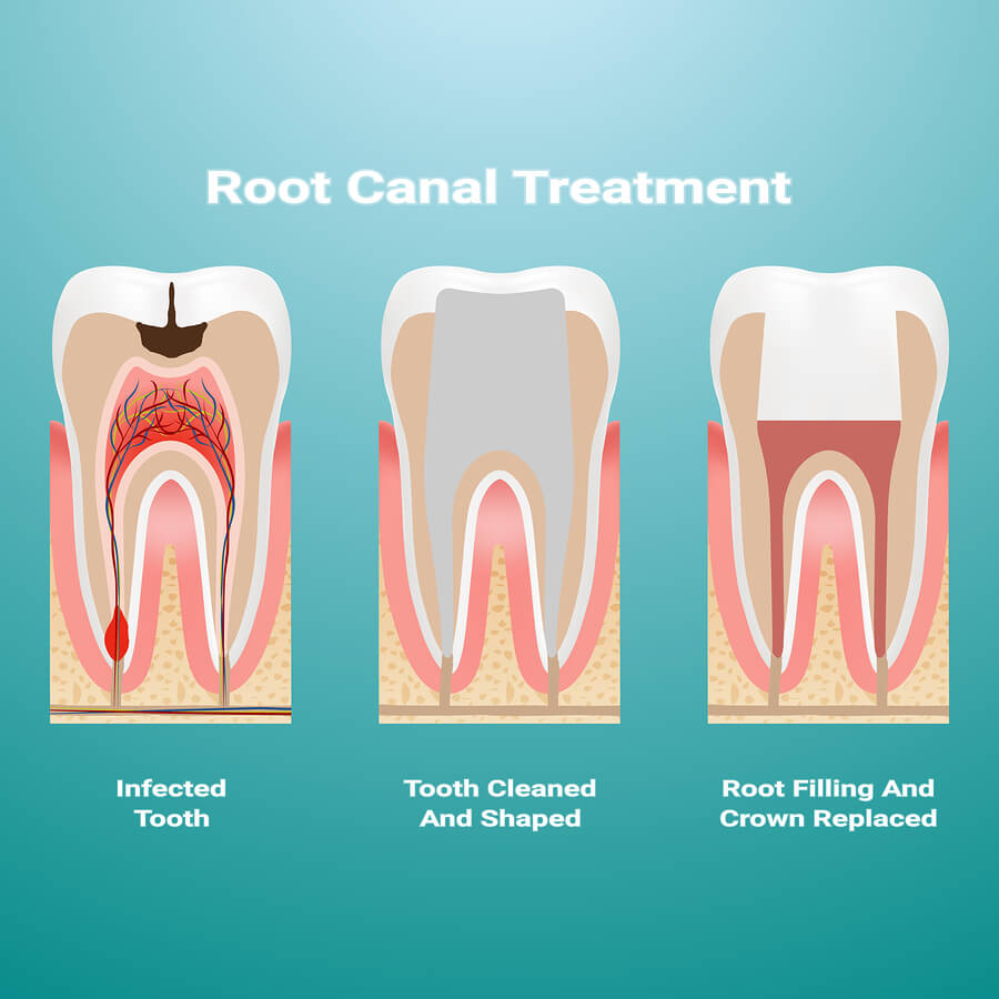 medicated filling vs root canal