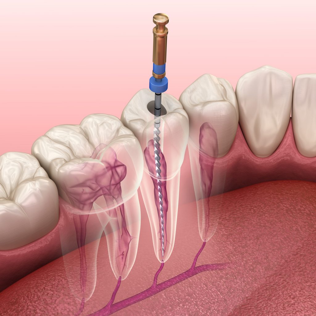 dental root canals services maple ridge