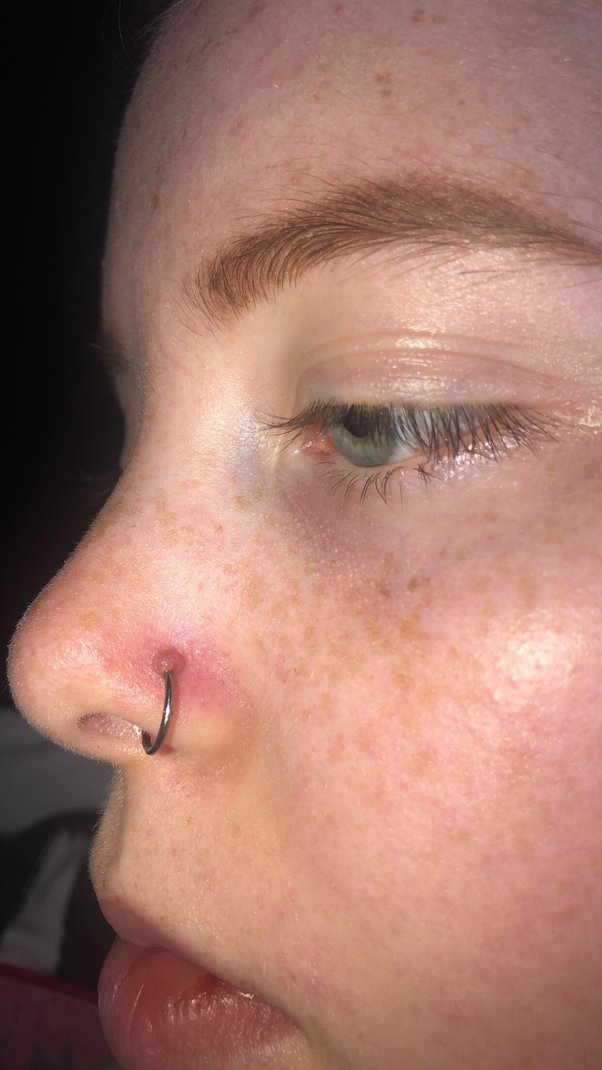 irritation bump nose piercing