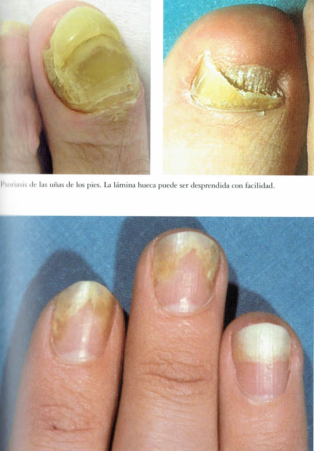 pintar uñas con psoriasis