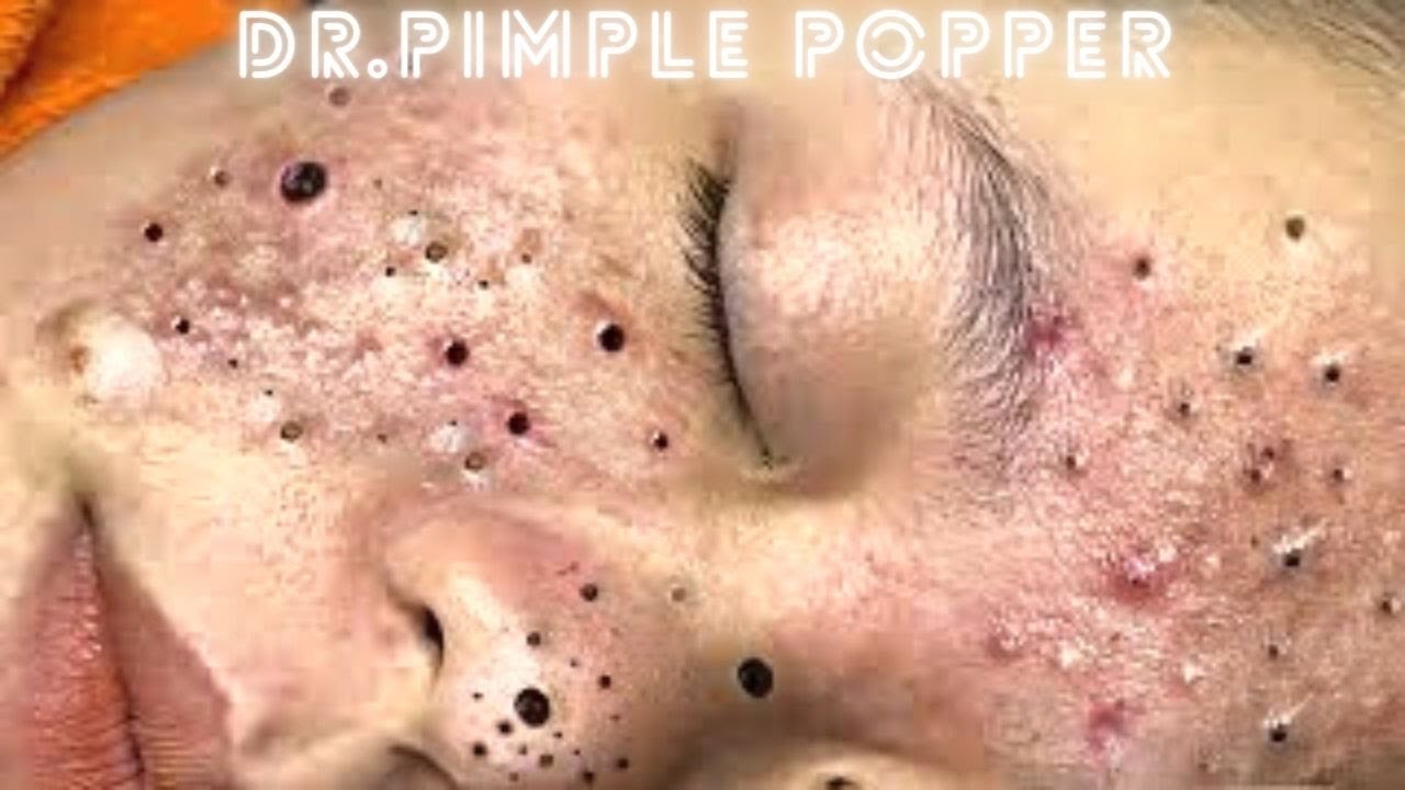 new dr pimple popper blackheads