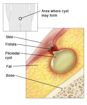 popped pilonidal cyst