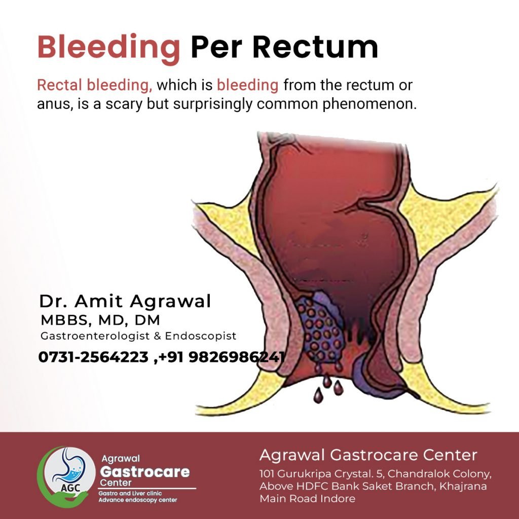 bright red blood per rectum icd 10