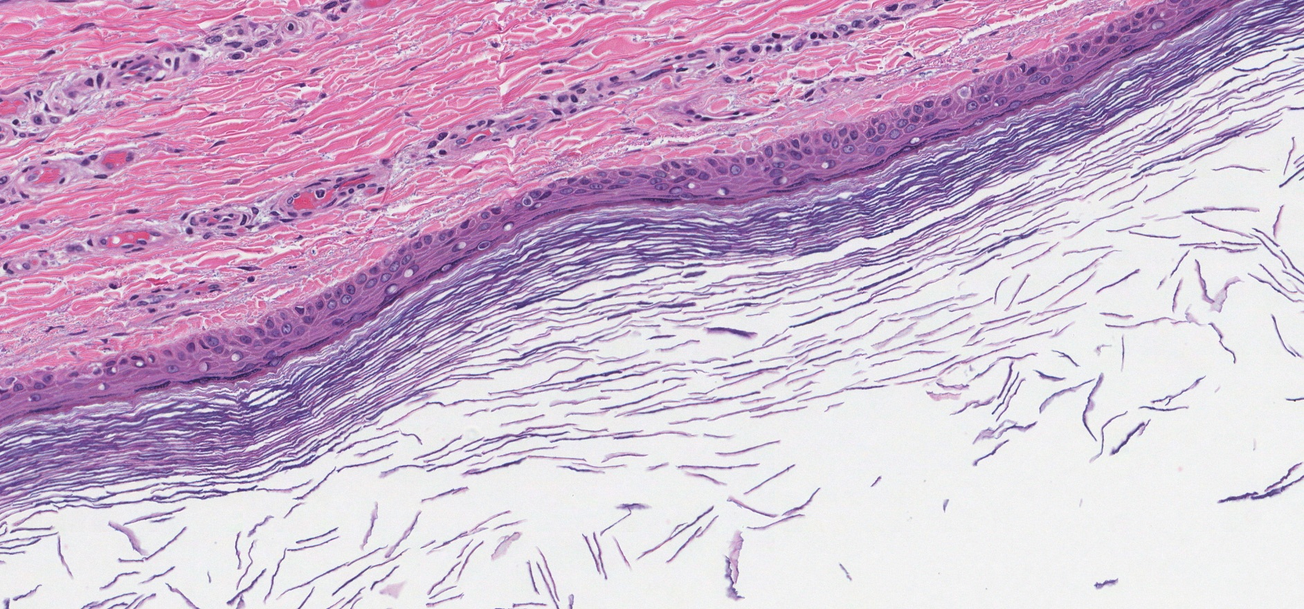 epidermoid cyst pathology outlines