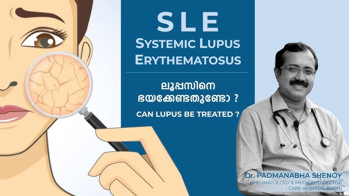 sle disease in malayalam