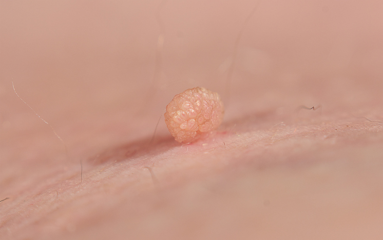 anal skin tag removal melbourne