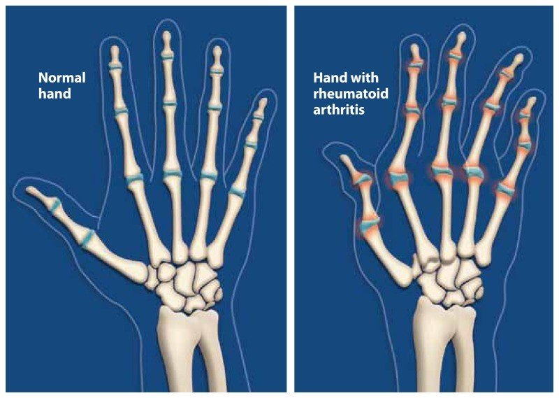 arthritis ne demek