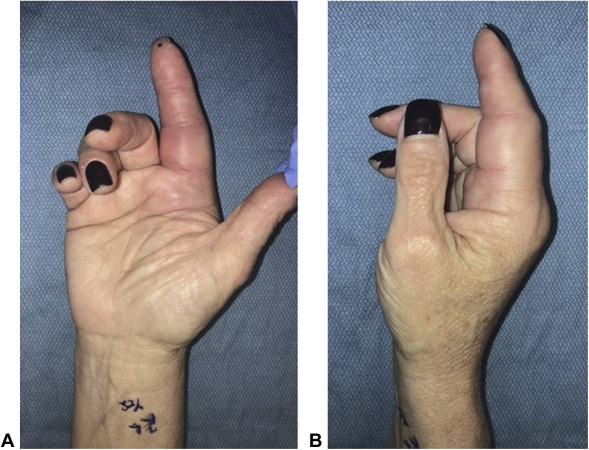 flexor tenosynovitis icd 10