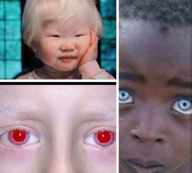 red eyes albino