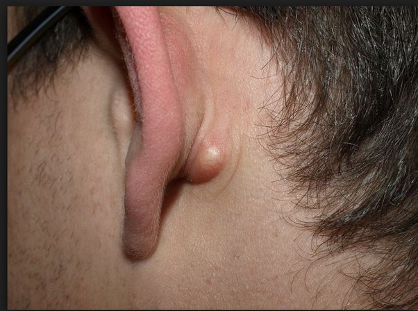 behind ear zit