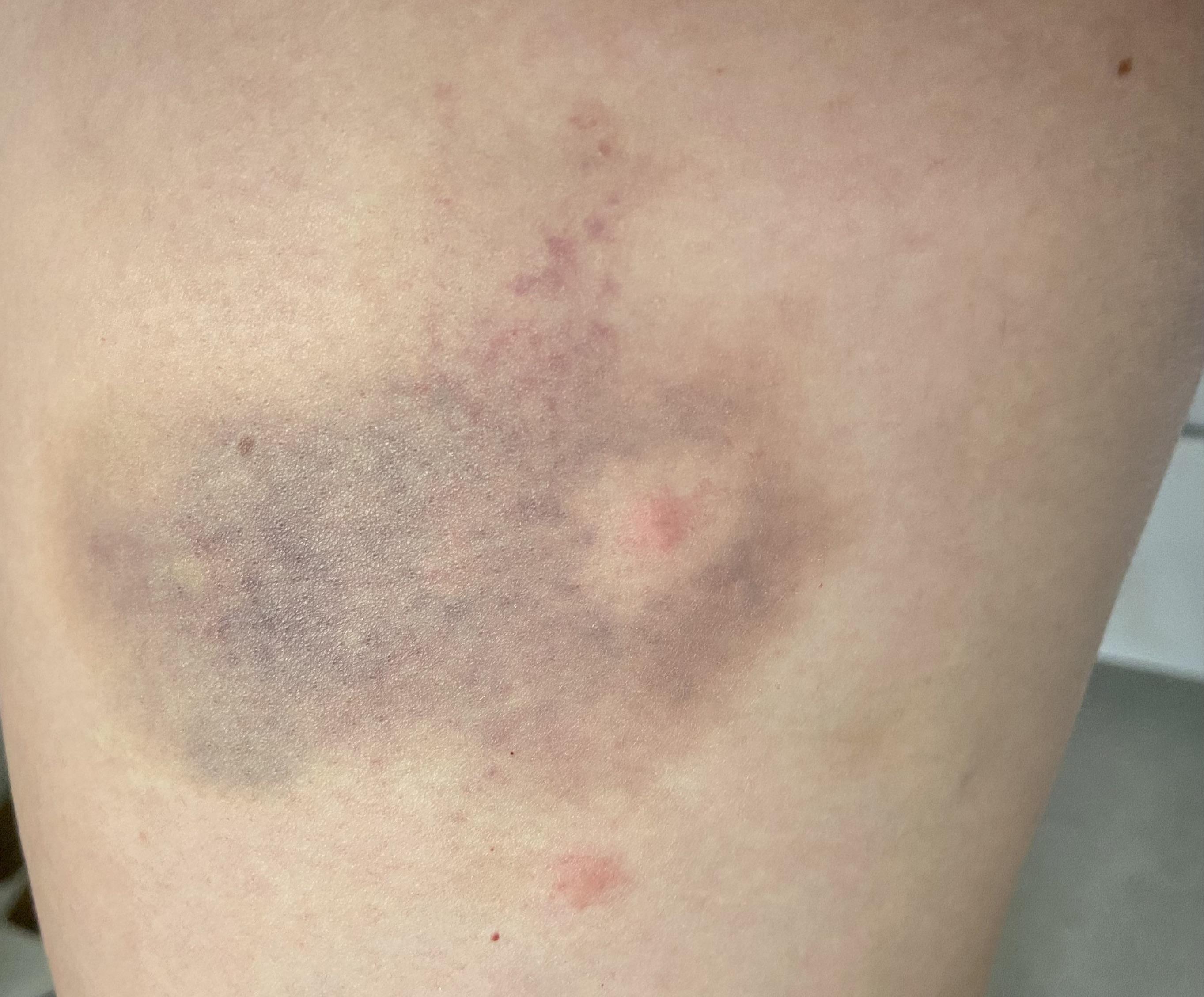 bruises mosquito bites