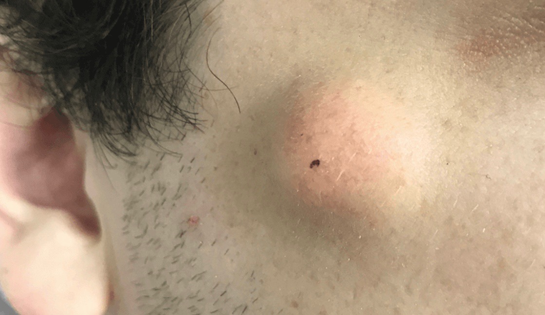 sebaceous cyst removal cost australia