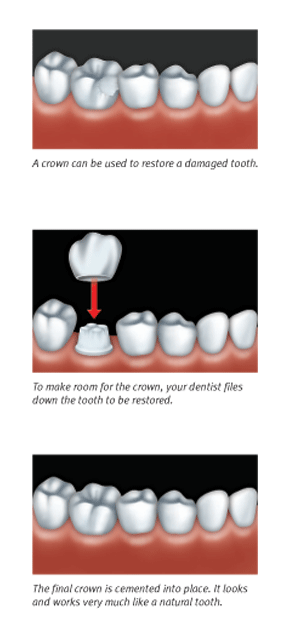 dental caps treatment maple ridge