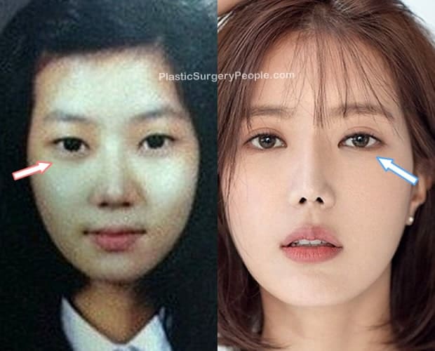 did im soo hyang have plastic surgery