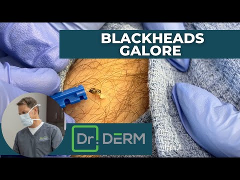 dr derm videos of squeezing blackheads