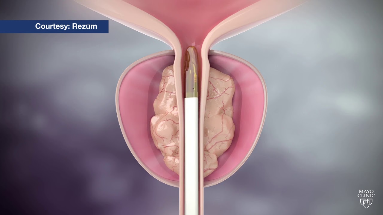 prostate massage therapy mayo clinic