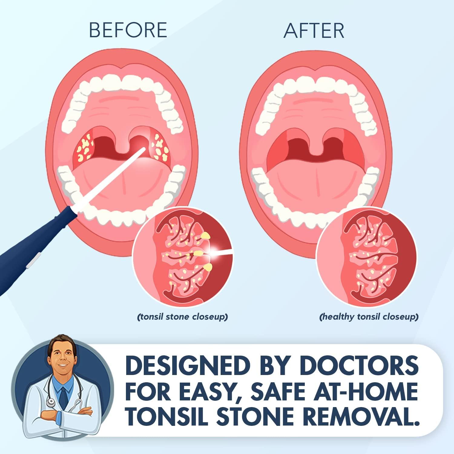 tonsil removal tool