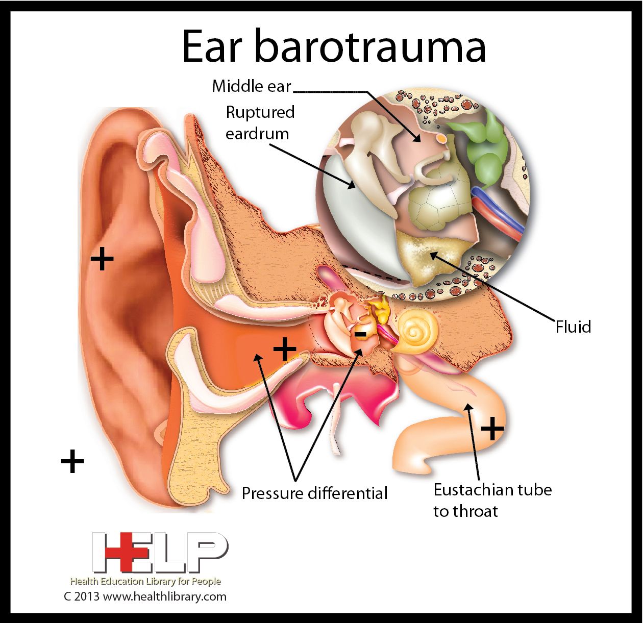 ear barotrauma home remedies