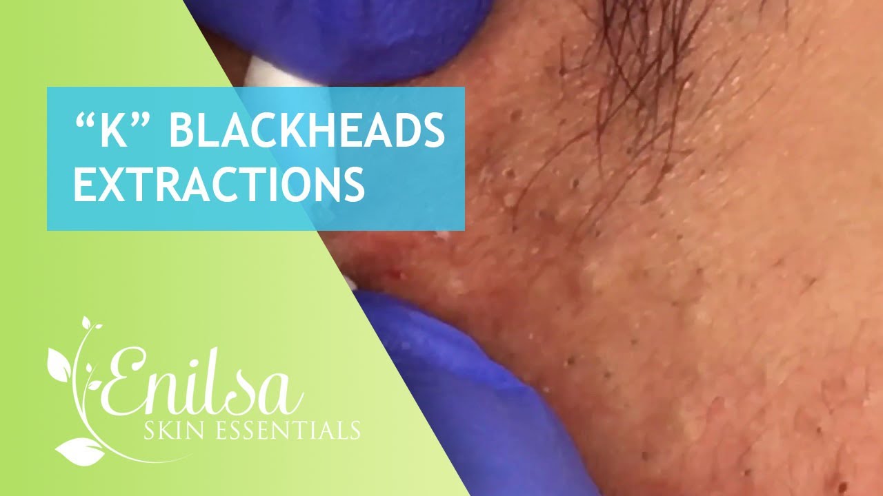 enilsa blackheads