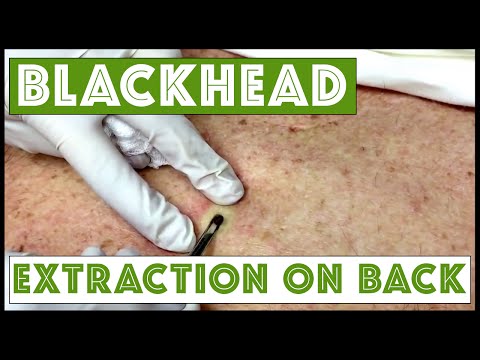 blackhead removal videos