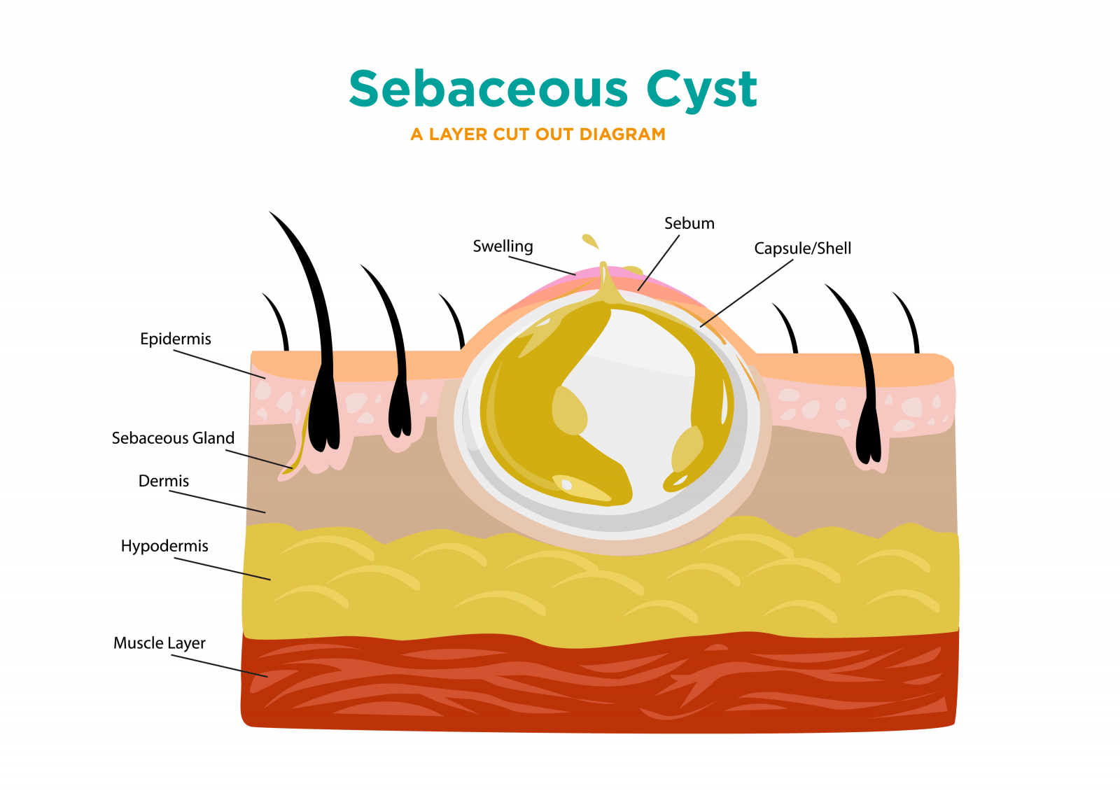 pilar cyst diagram