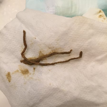 fiber strings in poop